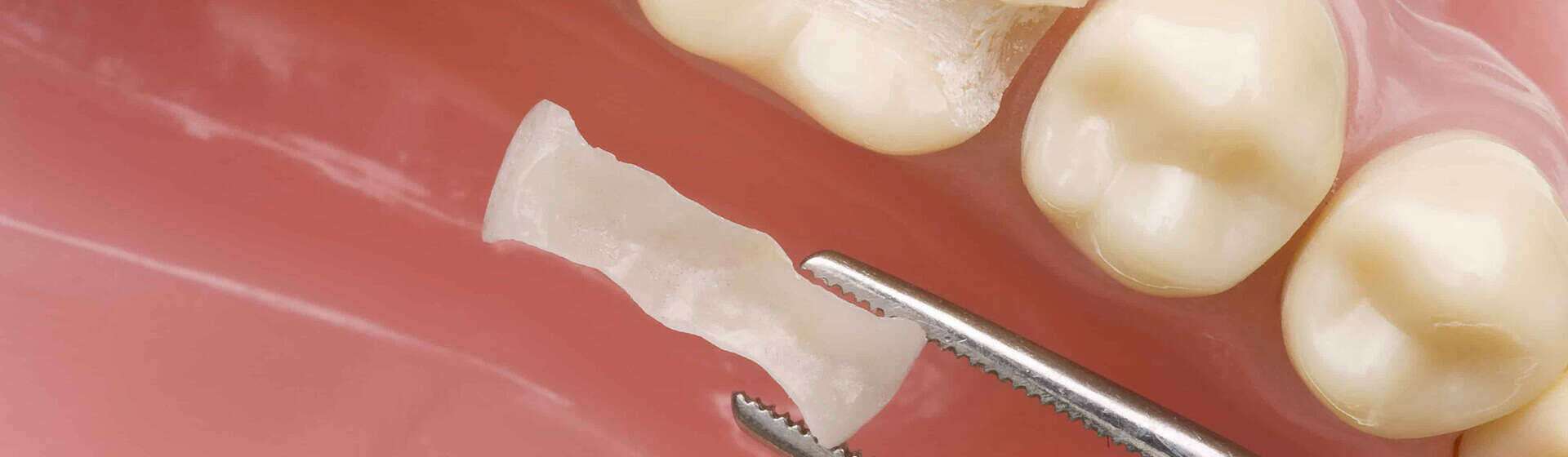 Dentistry Post-op Questions