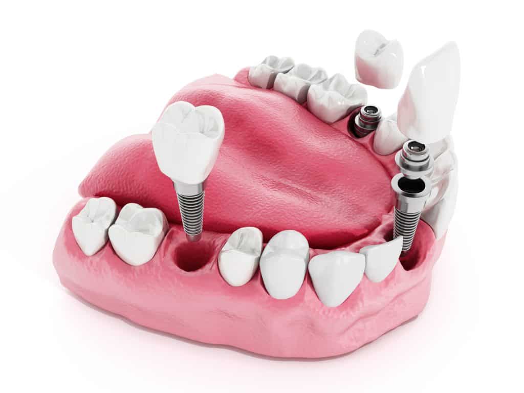 Image of dental implants in the mouth