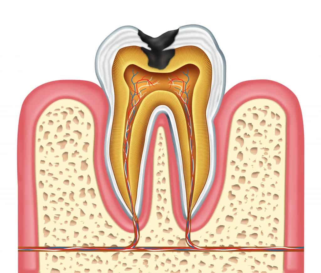 A cross section of a tooth with a cavity